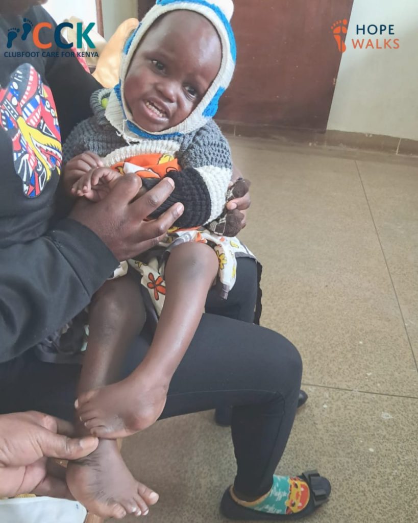 Clubfoot Relapse Case