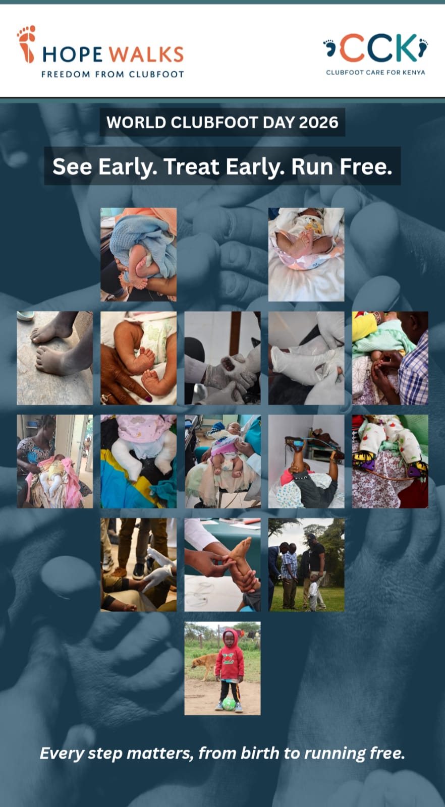 World Clubfoot Day 2026:                                                   See Early. Treat Early. Run Free