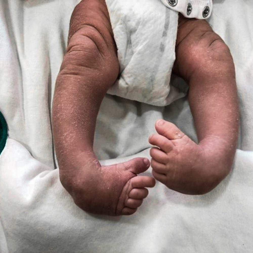 Clubfoot untreated patient at clubfoot Care for Kenya Hope Walks